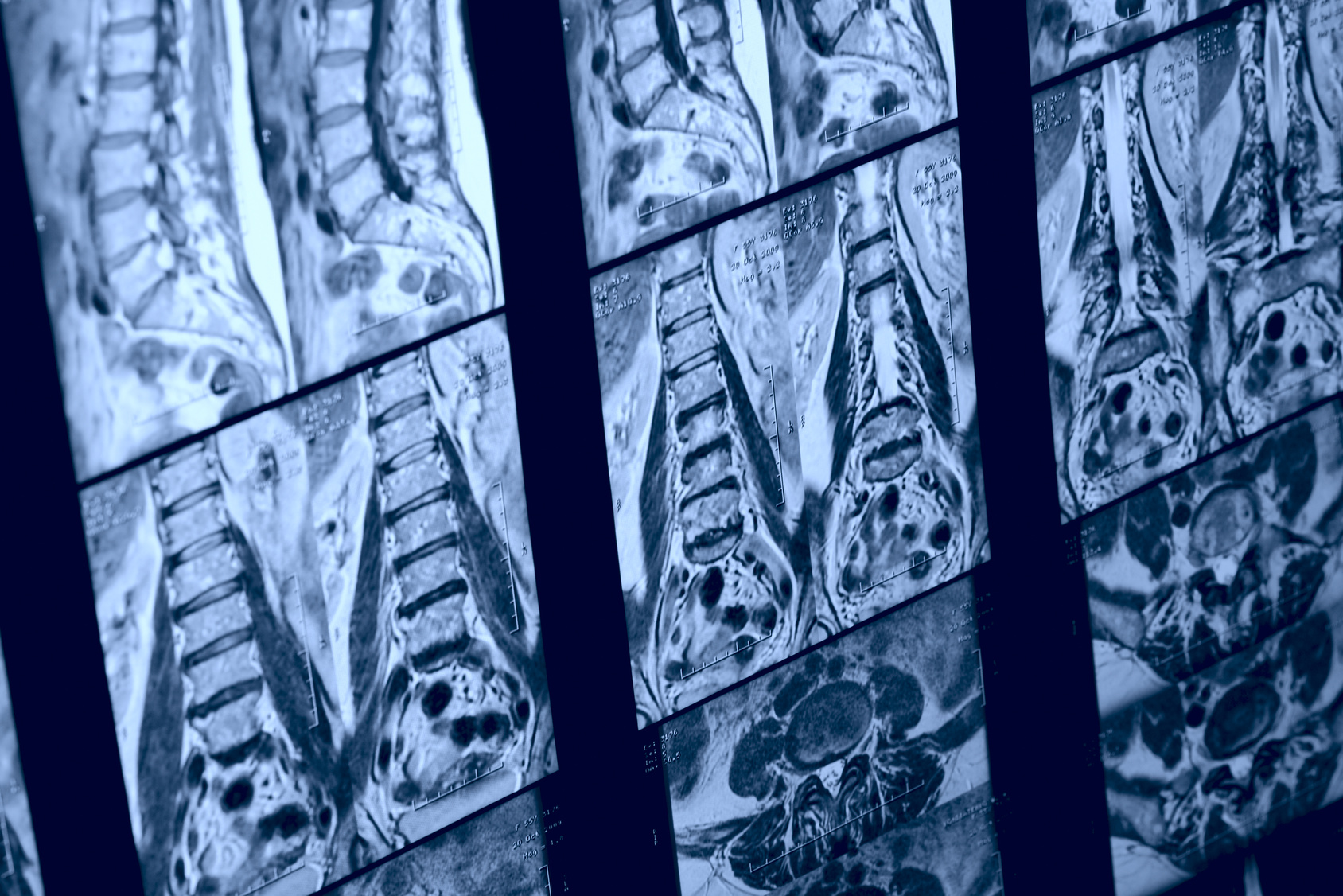 Real MRI scan of human spine, patient's data cloned out